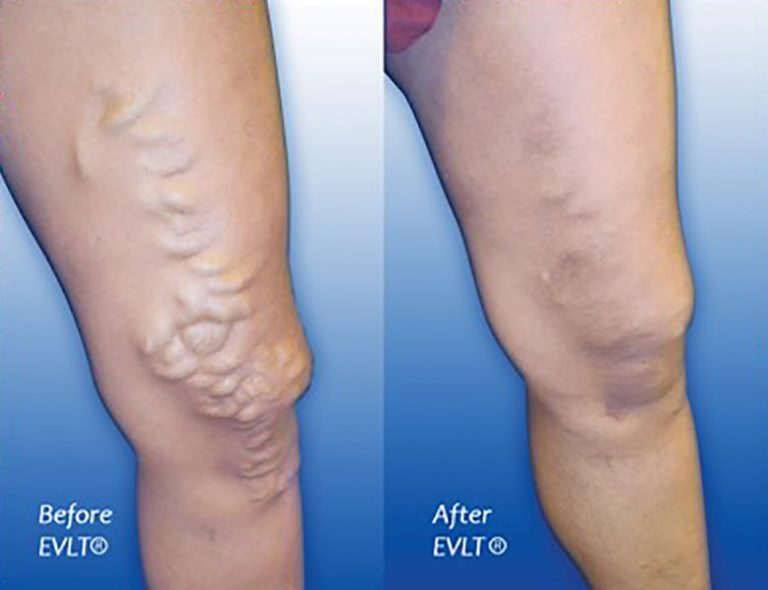 Varicose Veins Horizon Medical Spa High Point North Carolina 