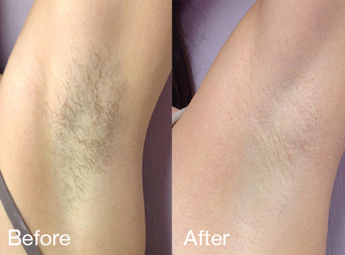 Laser Hair Removal Horizon Medical Spa High Point North Carolina