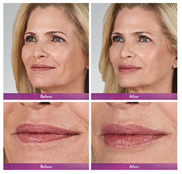 fillers volbella dermal botox swelling xc zuckerman augmentation